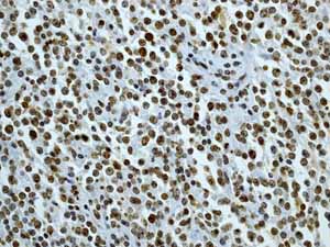 ab45694 showing positive staining in Lymphoma tissue.