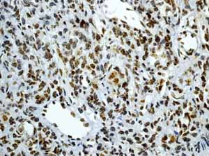 ab45694 showing positive staining in Prostatic carcinoma tissue.