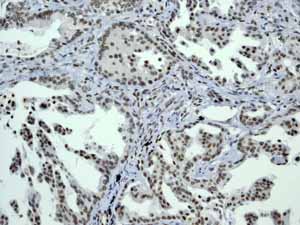 ab45694 showing positive staining in Lung carcinoma tissue.
