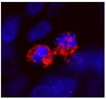 ab84697, at a dilution of 1/100, staining CENPF in formalin fixed, paraffin embedded human ewing sarcoma by Immunohistochemistry. Detection: Red fluorescent goat anti-rabbit IgG highly cross adsorbed antibody used at a dilution of 1/100.
