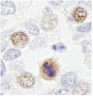 ab84697, at a dilution of 1/500, staining CENPF in formalin fixed, paraffin embedded human ewing sarcoma by Immunohistochemistry. Detection: DAB staining