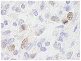 ab84697, at a dilution of 1/500, staining CENPF in formalin fixed, paraffin embedded human ewing sarcoma by Immunohistochemistry. Detection: DAB staining