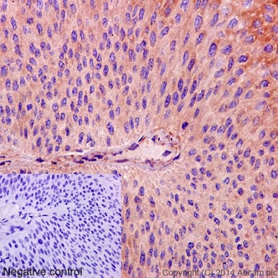 ab170414 staining CEP55 in Human transitional cell carcinoma of bladder tissue sections by Immunohistochemistry (IHC-P - paraformaldehyde-fixed, paraffin-embedded sections). Tissue was fixed and paraffin-embedded, antigen retrieval was by heat mediation in Tris/EDTA buffer pH9. Samples were incubated with primary antibody (1/400). An undiluted HRP-conjugated anti-rabbit IgG was used as the secondary antibody. Tissue counterstained with Hematoxylin. PBS was used in the negative control rather than the Primary antibody.