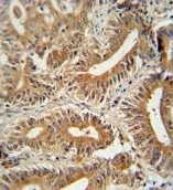 Iimmunohistochemical analysis of formalin-fixed, paraffin-embedded Human colon carcinoma tissue, labeling CEP89 with ab170218 at 1/10 dilution, followed by peroxidase-conjugated secondary antibody and DAB staining.