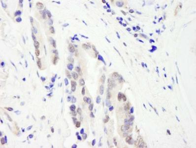 Immunohistochemical analysis of formalin-fixed paraffin-embedded Human prostate carcinoma tissue, labeling CHD3 using ab176804 at a 1/1000 dilution, followed by DAB staining.