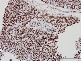 CHD4 antibody (ab54603) used in immunohistochemistry at 3ug/ml on formalin fixed and paraffin embedded human transitional cell carcinoma.