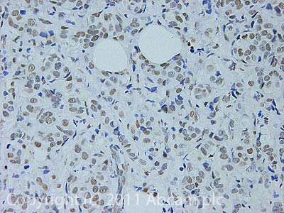 IHC image of ab4184 staining in Human Breast adenocarcinoma formalin fixed paraffin embedded tissue section, performed on a Leica BondTM system using the standard protocol F. The section was pre-treated using heat mediated antigen retrieval with sodium citrate buffer (pH6, epitope retrieval solution 1) for 20 mins. The section was then incubated with ab4184, 5µg/ml, for 15 mins at room temperature and detected using an HRP conjugated compact polymer system. DAB was used as the chromogen. The section was then counterstained with haematoxylin and mounted with DPX.For other IHC staining systems (automated and non-automated) customers should optimize variable parameters such as antigen retrieval conditions, primary antibody concentration and antibody incubation times.