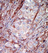 Staining of formalin-fixed and paraffin-embedded human breast cancer tissue with ab37560 at a 1/50 dilution (using a peroxidase-conjugated secondary antibody, followed by AEC staining). These data demonstrate the suitability of this antibody for immunohistochemistry; clinical relevance has not been evaluated.
