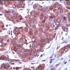 IHC staining of formalin-fixed, paraffin-embedded human breast carcinoma with prediluted ab32623. 