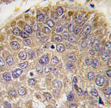 Immunohistochemistry analysis of formalin-fixed, paraffin-embedded Human hepatocarcinoma tissue using 1/10-1/50 ab80146, in conjunction with a peroxidase-conjugated secondary antibody, followed by DAB staining.
