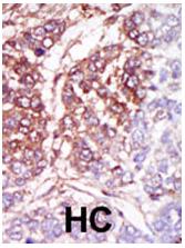 ab37950, at a 1/50 dilution, staining CK1 gamma 3 in human hepatocarcinoma by Immunohistchemistry, Formalin fixed Paraffin embedded tissue.