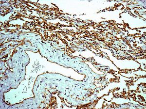 Immunohistochemical analysis of paraffin embedded Human lung tissue labelling Claudin 5 with ab131259 antibody at 1/100 dilution.
