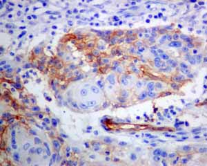 ab131259 showing positive staining in Squamous cell lung carcinoma tissue.