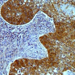 Immunohistochemical analysis of formalin-fixed, paraffin-embedded Human squamous lung carcinoma tissue labeling Claudin18 with ab203563 at 2 µg/mL followed by DAB staining. 20x magnification.