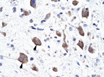 Immunohistochemisty analysis of human brain tissue labelling CLCN3 with ab28736.