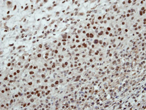 Immunohistochemical analysis of paraffin-embedded ES2 xenograft tissue labelled with ab151586 at 1/500 dilution.