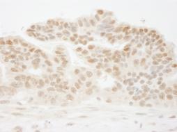 ab84529, at 1/250 dilution, staining cleavage stimulation factor in formalin-fixed, paraffin-embedded human ovarian carcinoma by Immunohistochemistry using DAB staining.