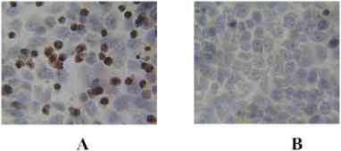 HeLa cells were induced into apoptosis with staurosporine at 0.5 µM for 5 hours (panel A) and were untreated as control (panel B). The cells were fixed in cold acetone for 5 minutes. Cells were incubated with the anti PARP cleavage site specific antibody (CCSA) at 10 µg/mL. Cells were then incubated with biotinylated goat anti-rabbit Igs followed by ABC and DAB. The data show that the anti-PARP CCSA specifically recognizes PARP in apoptotic cells. Taken together with Western blot data above, these data demonstrate the specificity of the anti-PARP CCSA for cleaved PARP.