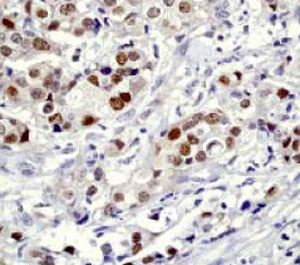 Immunohistochemical staining of paraffin embedded human breast carcinoma with unpurified ab32064 at a 1:100 dilution.