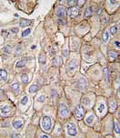 ab76592, at a 1/10 dilution, staining CLIC1 in formalin fixed, paraffin embedded human prostate carcinoma tissue by Immunohistochemistry. ab76592 was peroxidase conjugated to the secondary antibody, followed by DAB staining.