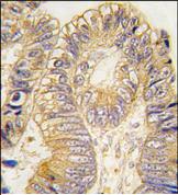 ab75948, at 1/10 dilution, staining CLIC5 in formalin-fixed, paraffin-embedded human colon carcinoma tissue by Immunohistochemistry. ab75948 was peroxidase conjugated to the secondary antibody, followed by DAB staining.