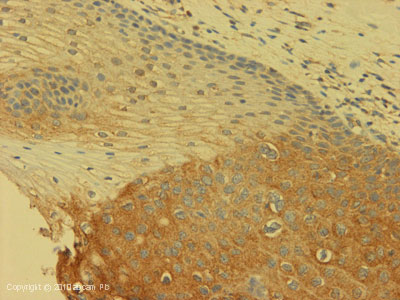 IHC image of Ab61830 staining in Human Cervical carcinoma formalin fixed paraffin embedded tissue section, performed on a Leica BondTM system using the standard protocol F. The section was pre-treated using heat mediated antigen retrieval with sodium citrate buffer (pH6, epitope retrieval solution 1) for 20 mins. The section was then incubated with Ab61830, 5µg/ml, for 15 mins at room temperature and detected using an HRP conjugated compact polymer system. DAB was used as the chromogen. The section was then counterstained with haematoxylin and mounted with DPX. For other IHC staining systems (automated and non-automated) customers should optimize variable parameters such as antigen retrieval conditions, primary antibody concentration and antibody incubation times.