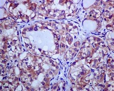 Immunohistochemical analysis of paraffin embedded papillary adenocarcinoma of Human thyroid gland tissue labelling CLPTM1 with ab133756 at 1/50.