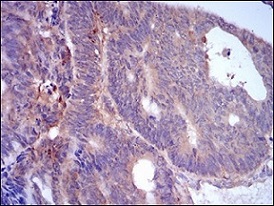 Immunohistochemical analysis of paraffin-embedded Human rectum cancer tissue labeling ADFP with ab181452 at 1/200 dilution.