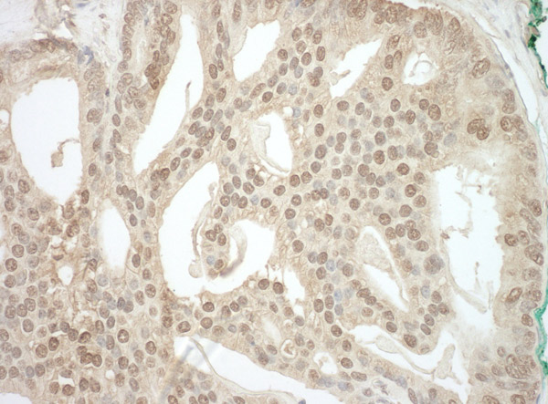 Immunohistochemistry (Formalin/PFA-fixed paraffin-embedded sections) analysis of human prostate carcinoma tissue labelling ADRM1 with ab91567 at 1/1000 (1µg/ml). Detection: DAB.
