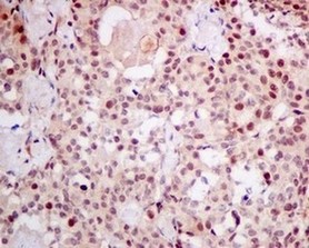 Immunohistochemical analysis of paraffin embedded Human thyroid gland carcinoma tissue labeling ADRM1 with ab157218 at 1/50.