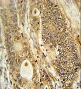 Immunohistochemical analysis of paraffin embedded Human colon carcinoma tissue labeling Advillin with ab175126 at 1/50 followed by peroxidase conjugation of the secondary antibody and DAB staining.