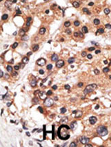 Ab60083 (1/50-1/100) staining human AF9 in human cancer tissue by immunohistochemistry using formalin fixed, paraffin embedded tissue. Formalin-fixed and paraffin-embedded human cancer tissue reacted with the primary antibody, which was peroxidase-conjugated to the secondary antibody, followed by AEC staining. HC = hepatocarcinoma.