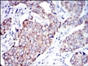 ab119917 at 1/200 dilution staining AIF in paraffin-embedded Human breast cancer tissue by Immunohistochemistry followed by DAB staining.