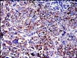 ab119917 at 1/200 dilution staining AIF in paraffin-embedded Human cervical cancer tissue by Immunohistochemistry followed by DAB staining.