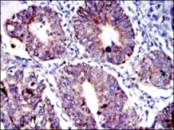 ab119917 at 1/200 dilution staining AIF in paraffin-embedded Human rectum cancer tissue by Immunohistochemistry followed by DAB staining.