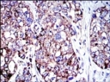 ab119917 at 1/200 dilution staining AIF in paraffin-embedded Human lung cancer tissue by Immunohistochemistry followed by DAB staining.