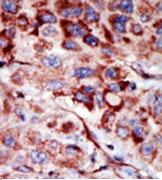 ab71729, at a 1/50 dilution, staining AK2 in formalin fixed, paraffin embedded human cancer tissue (hepatocarcinoma) by Immunohistochemistry. ab71729 was peroxidase conjugated to the secondary antibody, followed by AEC staining.
