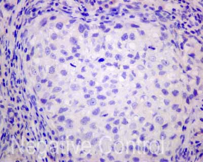ab173298 showing -ve staining in Human breast carcinoma tissue.