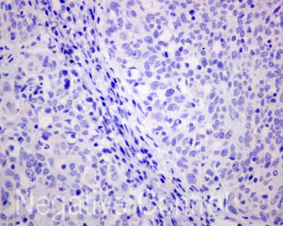 ab173298 showing -ve staining in Human cervical carcinoma tissue.