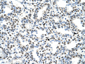 Immunohistochemistry (Formalin/PFA-fixed paraffin-embedded sections) analysis of human lung tissue labelling AKAP8L with ab51342 at 4-8µg/ml. Arrows indicate positively labelled alveolar cells. Magnification: 400X.