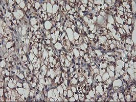 ab124341 at 1/150 dilution staining AKT1 in Paraffin-embedded Human kidney carcinoma tissue by Immunohistochemistry.