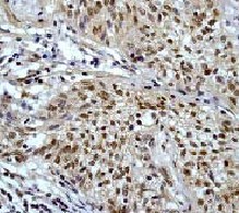 Immunohistochemistry (Paraffin-embedded sections) analysis using ab32038 at a dilution of 1/1000 - 1/1250 and squamous lung carcinoma