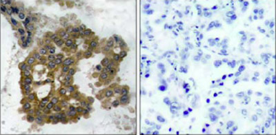 This image shows human lung carcinoma tissue stained with ab38513 at 1/50 dilution.Image on left: untreated.Image on right: treated with phosphopeptide at 1µg/ml (negative control).