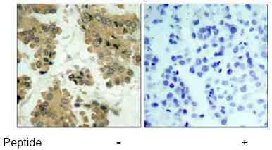 Ab39663 staining human AKT2 in human lung carcinoma tissue by immunohistochemistry using paraffin embedded tissue.