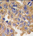 Formalin-fixed, paraffin-embedded human lung carcinoma tissue reacted with ab71045 at a 1:10 dilution, which was peroxidase-conjugated to the secondary antibody, followed by DAB staining.