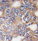 ab70917, at a 1/10 dilution, staining human ALDH2 in hepatocarcinoma, using Immunohistochemistry, Formalin/PFA fixed Paraffin embedded tissue. ab70917 was peroxidase-conjugated to the secondary antibody, followed by DAB staining. 