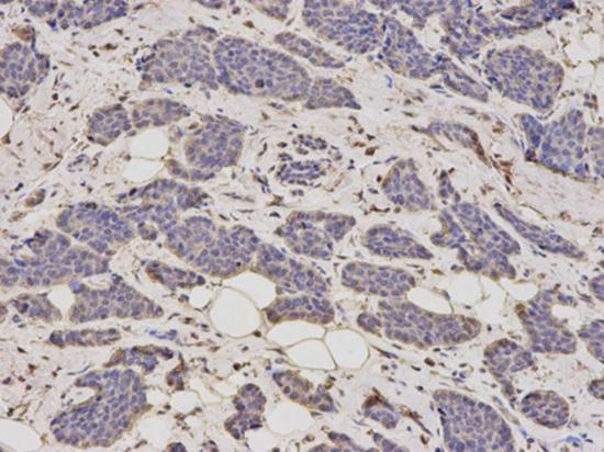 Immunohistochemical analysis of paraffin-embedded Human breast cancer tissue labeling ALDH4A1 using ab196612 at a 1/200 dilution.