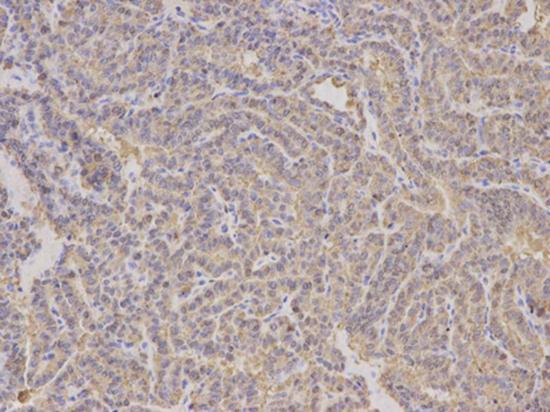 Immunohistochemical analysis of paraffin-embedded Human thyroid cancer tissue labeling ALDH4A1 using ab196612 at a 1/200 dilution.