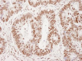 ab82550, at a 1:250 dilution, staining Human 53BP1 (phospho Ser25) in colon adenocarcinoma (mock phosphatase treated section), using Immunohistochemistry, Formalin/PFA-fixed paraffin-embedded tissue.