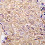 ab63181 staining of human breast carcinoma tissue by formalin-fixed and parrafin-embedded IHC.    